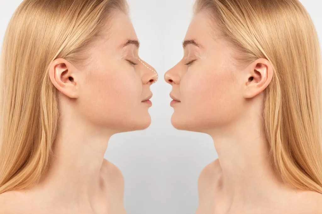 rhinoplasty in iran